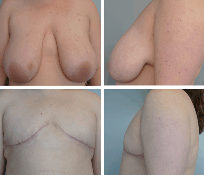 Before and after nonbinary top surgery by Dr. Tina Jenq in Portland
